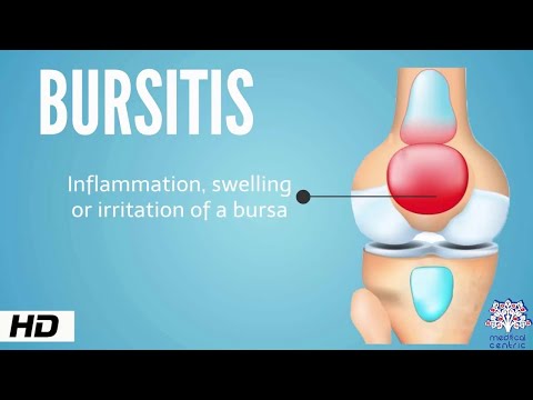 Bursitis, Causes, Signs and Symptoms, Diagnosis and Treatment.