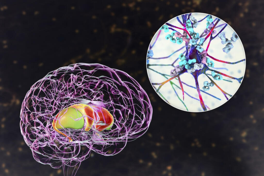 Anti-neuronal antibodies, anti-basal ganglia antibodies. 3D illustration shows immunoglobulins attacking neurons in the dorsal striatum of human brain. They are found in post-rheumatic fever chorea