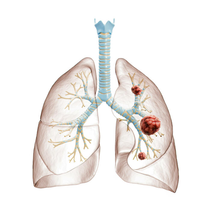 Lung cancer or carcinoma 3D rendering illustration. Bronchial tree and lungs infected by cancer cells on white background. Medical, healthcare, oncology, disease, science concept.