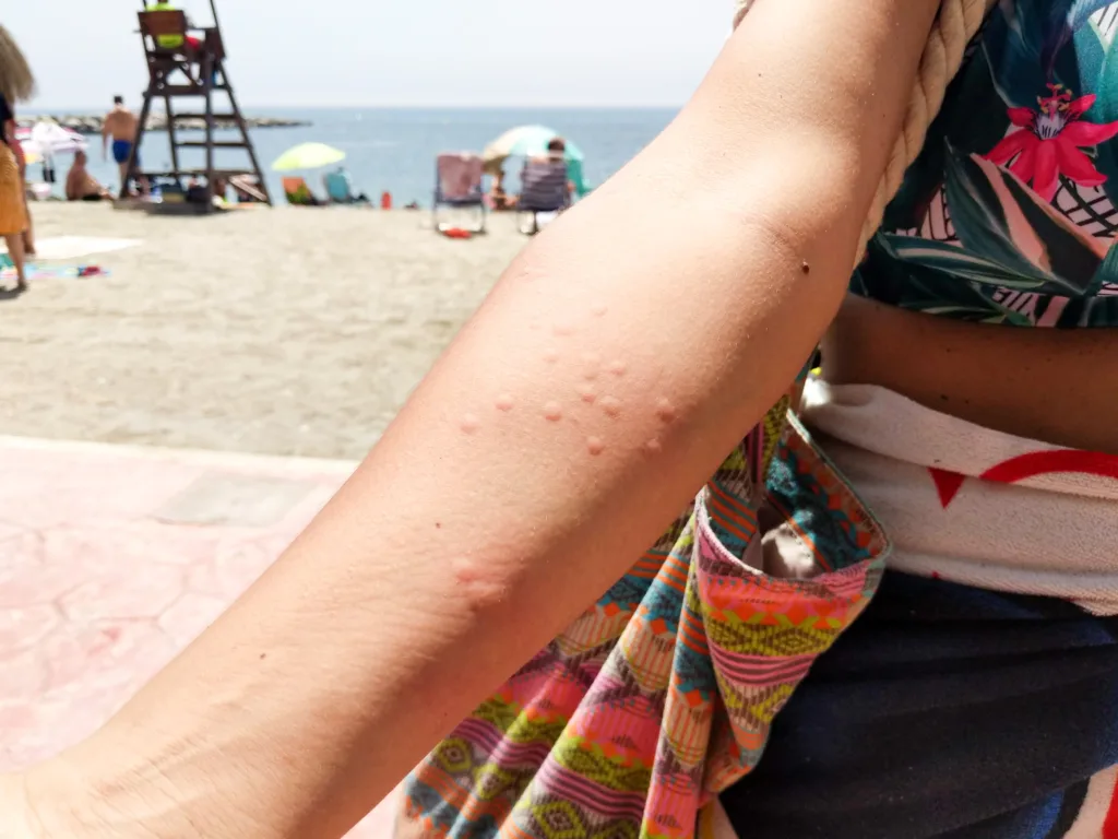 Jellyfish sting in the arm of a woman on the beach, horizontal