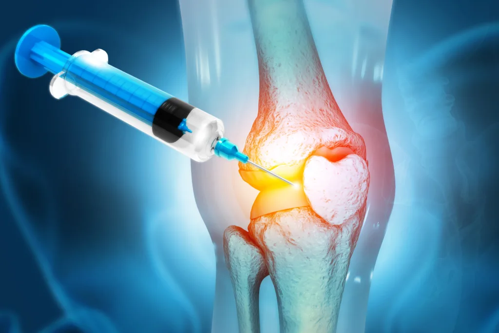 Anatomy Human Knee Joint Treatment, Osteoarthritis Injection, Drug Method Injection, knee injury, 3d illustration