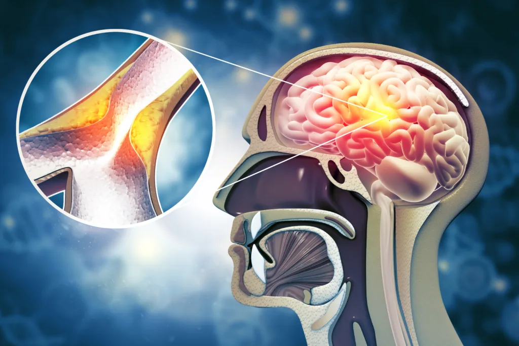 Atherosclerosis Stroke. A blood clot in the vessels of the human brain. 3d illustration