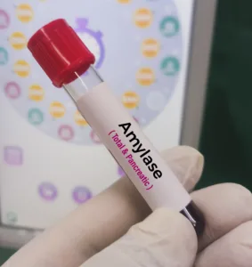 Biochemist or Lab Technologist holds Blood sample for Amylase (Total and Pancreatic) test. Diagnosis of pancreatitis in the laboratory background.