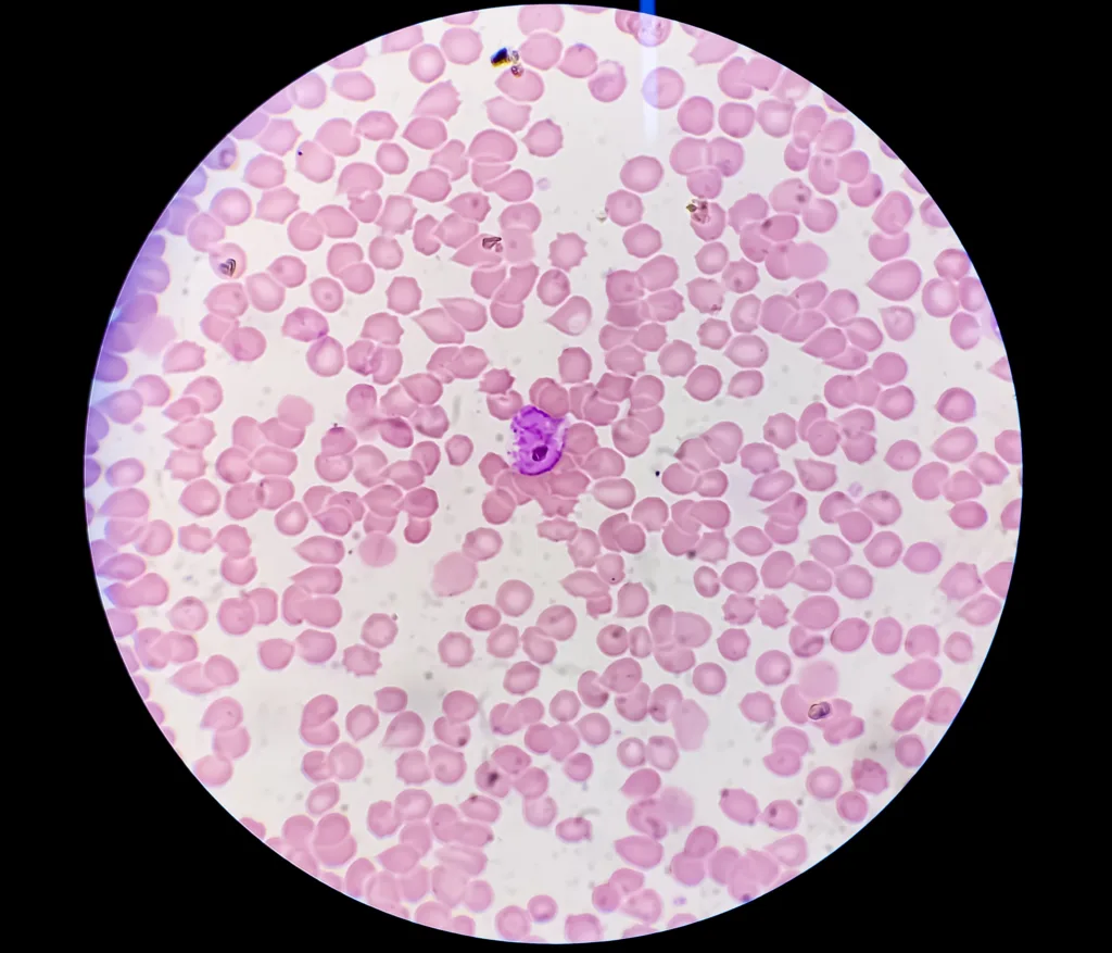 Plasmodium vivax in thin film under microscopy, Malaria disease. P. vivax, Malaria parasite in red blood cells