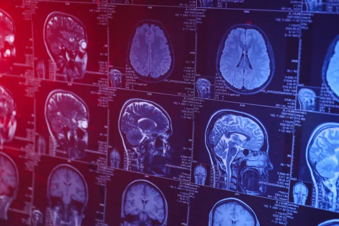 MRI or magnetic resonance imaging of the head and brain. Close up