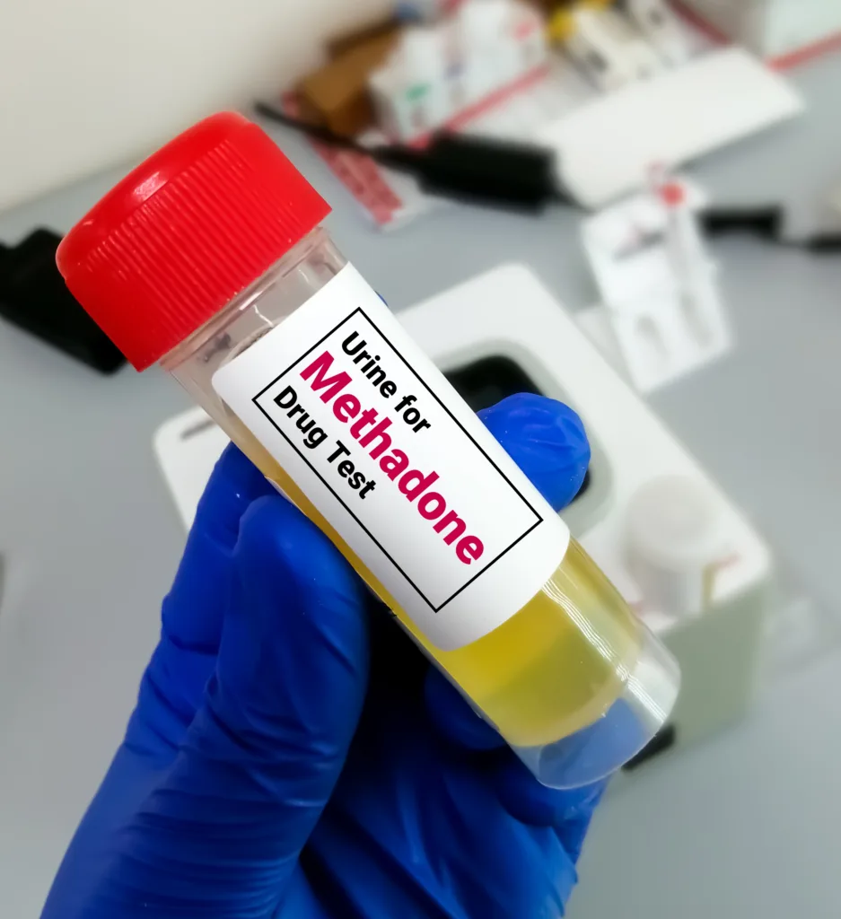 Urine sample for Methadone test, Methadone is a medication used to treat Opioid Use Disorder (OUD)